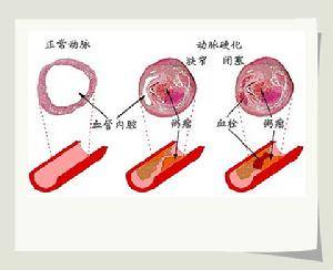 闭塞性动脉硬化症