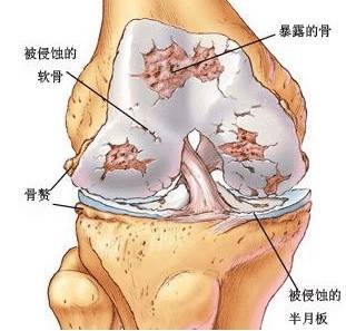 风湿痛