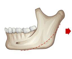 下颌角整形手术