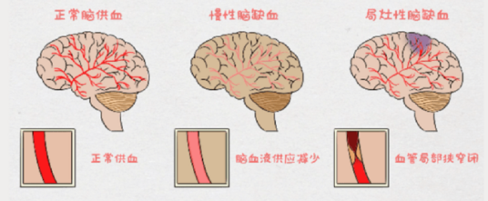 脑缺血