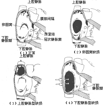 心房间隔缺损