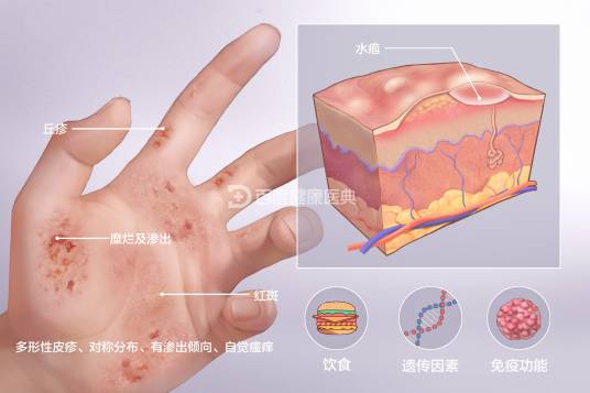 湿疹（皮肤炎症反应）