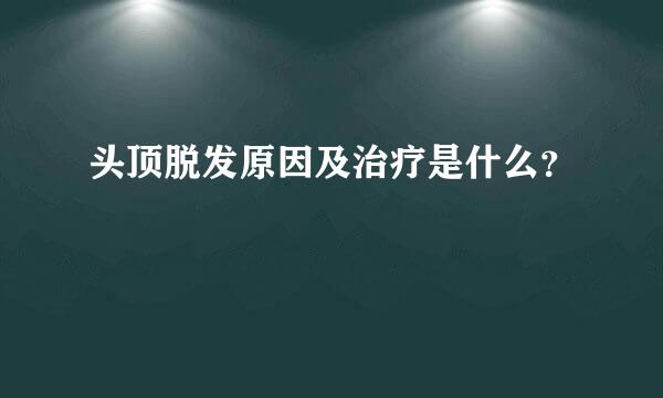 头顶脱发原因及治疗是什么？