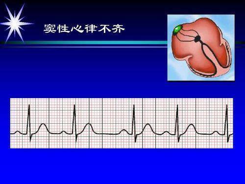 体检报告说我窦性心律不齐，是什么意思？