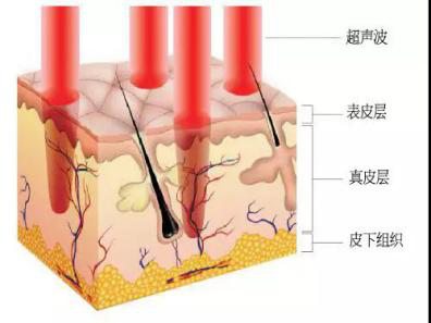 什么是超声刀美容？