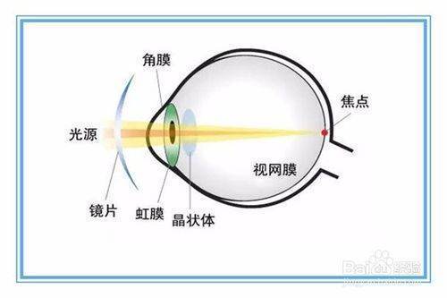 散光矫正办法有哪些？