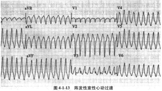 阵发性室性心动过速的心电图特点。