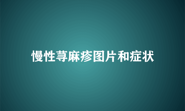 慢性荨麻疹图片和症状