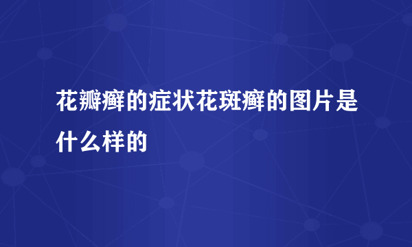 花瓣癣的症状花斑癣的图片是什么样的